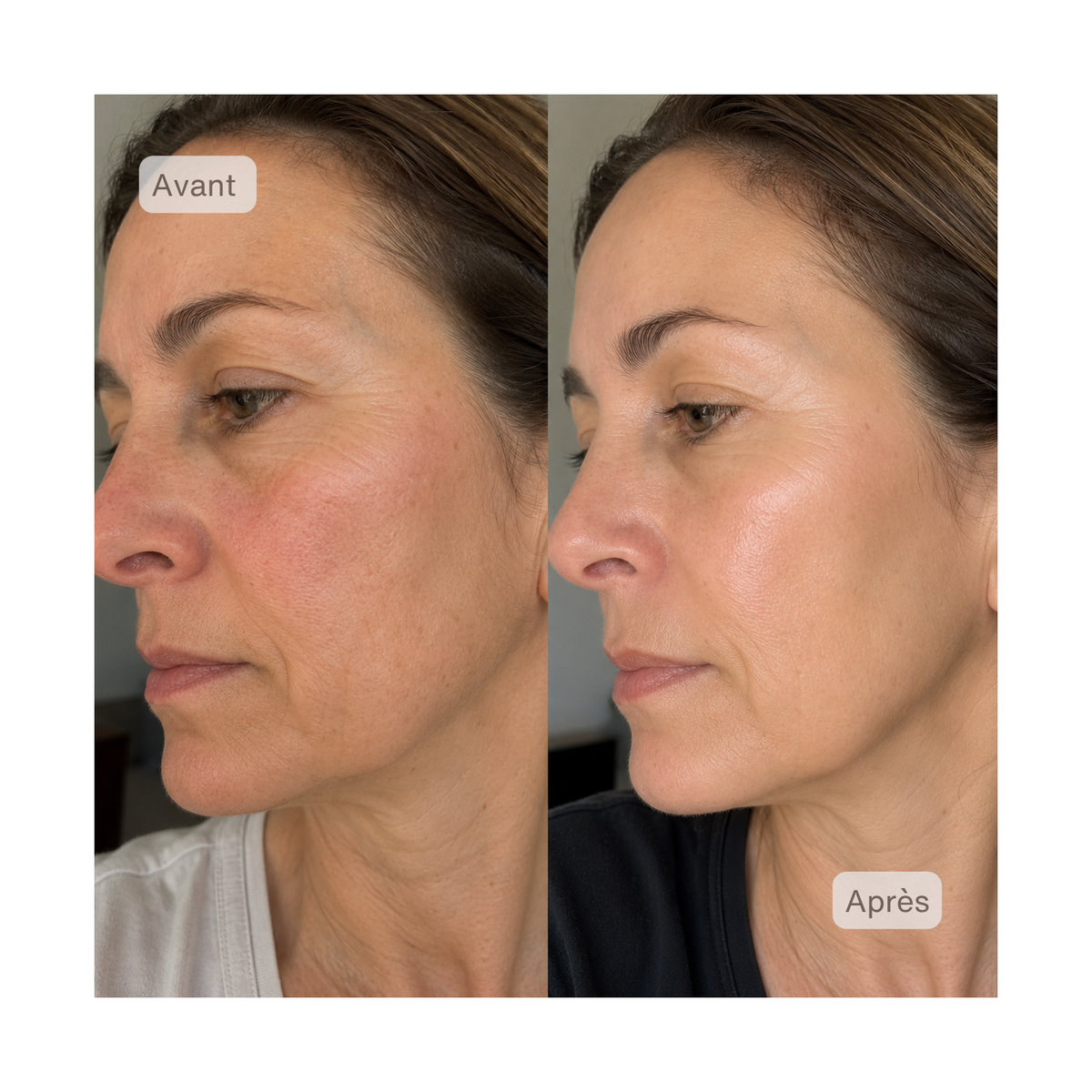 Neodermy LED-Gesichtsmaske – Rot- & Infrarot-Lichttherapie