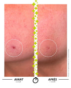 Sérum Garancia L'ELIXIR DU MARABOUT: Comparación antes/después en 7 días que muestra la eficacia de un tratamiento Garancia en una imperfección de la piel específica. La piel está visiblemente más clara y el relieve cutáneo se alisa.