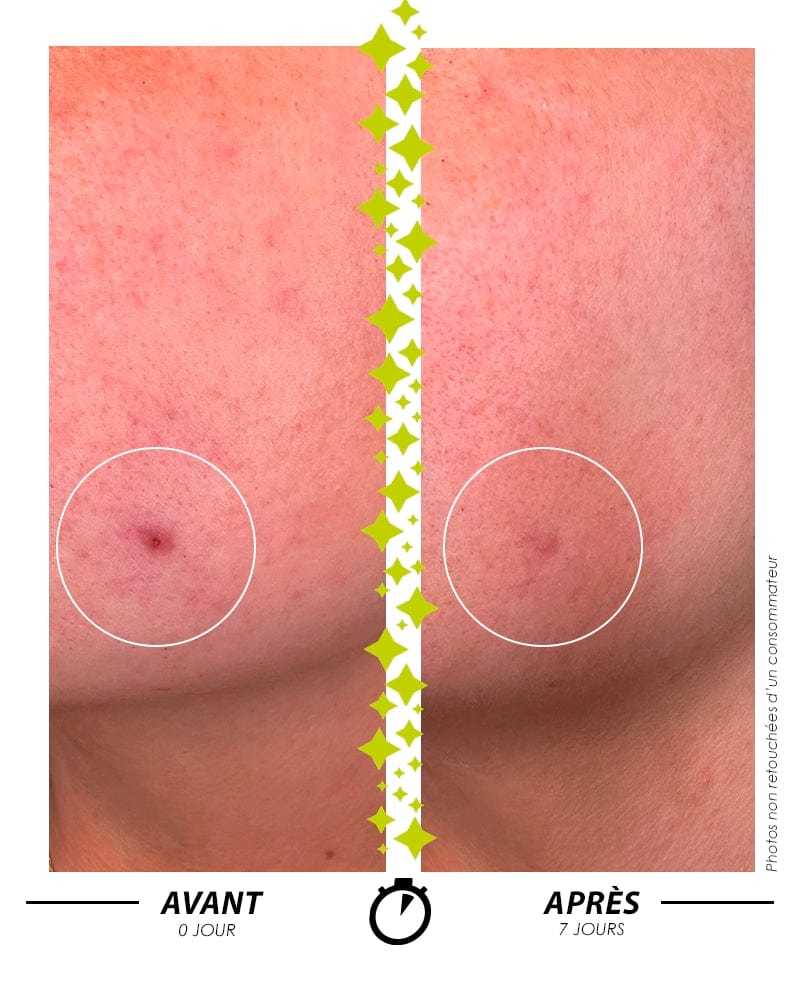 Sérum Garancia L'ELIXIR DU MARABOUT: Comparación antes/después en 7 días que muestra la eficacia de un tratamiento Garancia en una imperfección de la piel específica. La piel está visiblemente más clara y el relieve cutáneo se alisa.