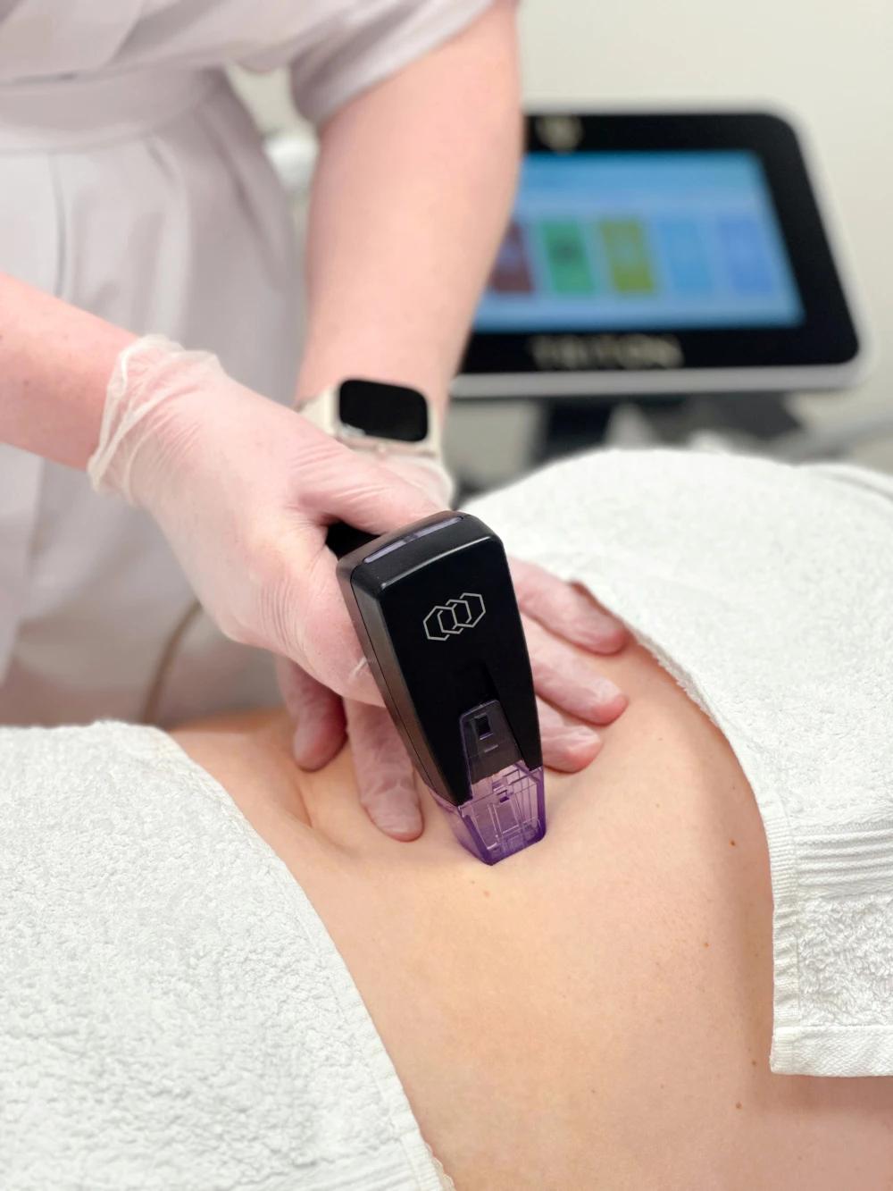 Morpheus8® Corps 2 Zones – Radiofréquence Microneedling